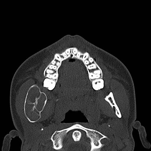 Aneurysmal bone cyst of the mandible (Radiopaedia 43280-46601 Axial bone window 46).jpg