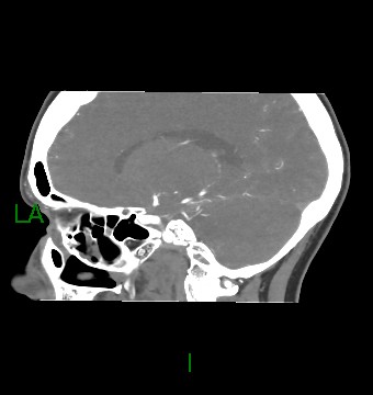 File:Aneurysmal subarachnoid hemorrhage with intra-axial extension (Radiopaedia 84371-99732 B 27).jpg