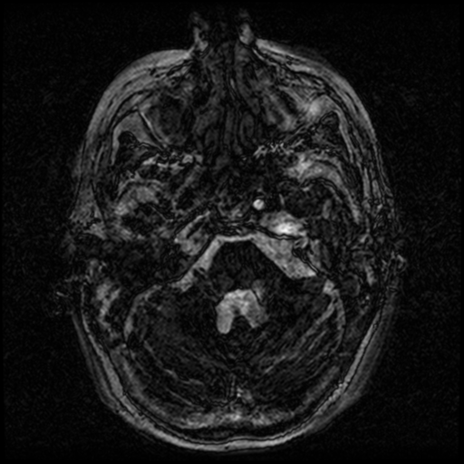 Angioinvasive aspergillosis in the pituitary fossa (Radiopaedia 39676-42010 Ax 3D FIESTA VOLUME 12).png
