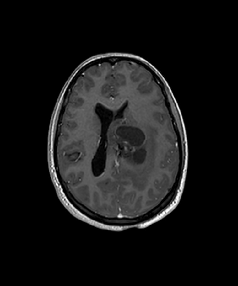 Angiomatous meningioma (Radiopaedia 79459-92577 Axial T1 C+ 3D ISO 16).jpg