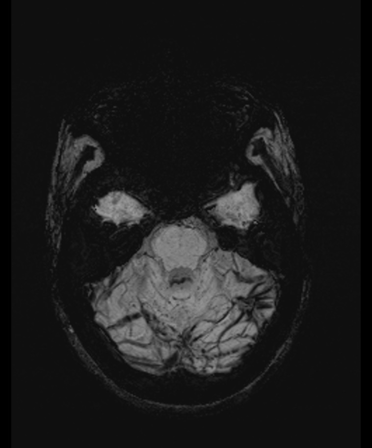 Angiomatous meningioma (Radiopaedia 79459-92579 E 17).jpg