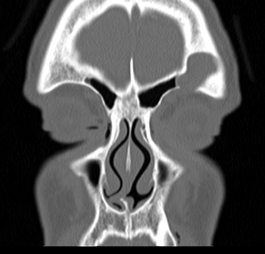 Angular epidermoid cyst (Radiopaedia 46908-51439 Coronal bone window 19).png