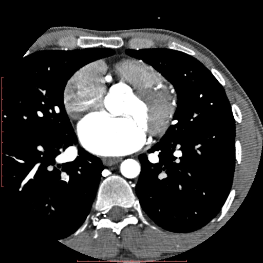 File:Anomalous left coronary artery from the pulmonary artery (ALCAPA) (Radiopaedia 70148-80181 A 154).jpg