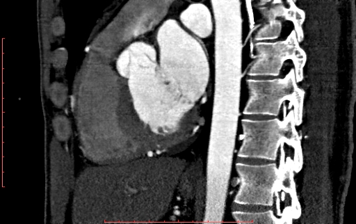 File:Anomalous left coronary artery from the pulmonary artery (ALCAPA) (Radiopaedia 70148-80181 C 132).jpg