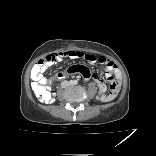 Anorectal carcinoma (Radiopaedia 44413-48064 A 32).jpg