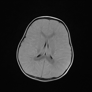 File:Anoxic brain injury (Radiopaedia 79165-92139 Axial FLAIR 17).jpg