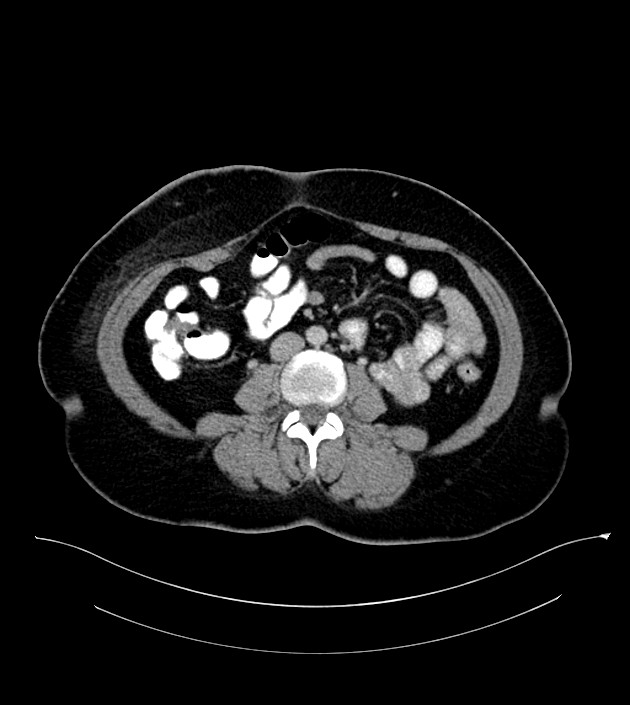 Anterior abdominal wall CSF pseudocyst (CSFoma) (Radiopaedia 79453-92571 A 52).jpg