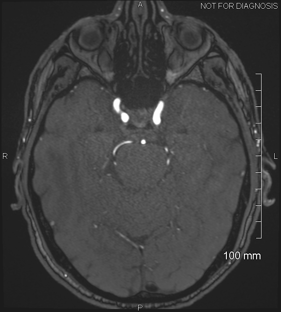 Anterior cerebral artery aneurysm (Radiopaedia 80683-94127 Axial MRA 80).jpg