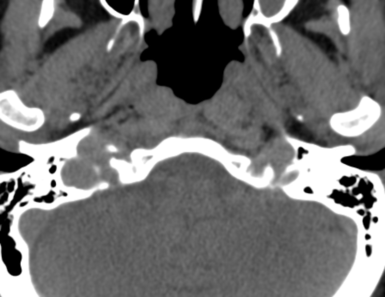 Anterior cervical postdiscectomy arthrodesis (Radiopaedia 32678-33646 Axial non-contrast 3).jpg