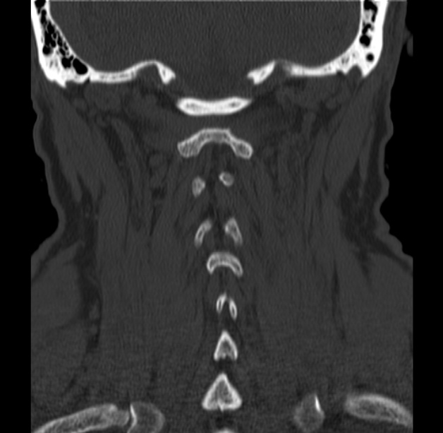 Anterior cervical postdiscectomy arthrodesis (Radiopaedia 32678-33646 Coronal bone window 53).jpg
