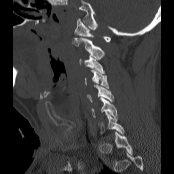 Anterior cervical postdiscectomy arthrodesis (Radiopaedia 32678-33646 Sagittal bone window 23).jpg