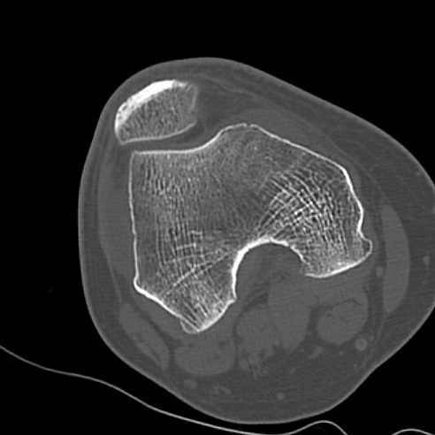 File:Anterior cruciate ligament avulsion fracture (Radiopaedia 58939-66194 Axial bone window 2).jpg