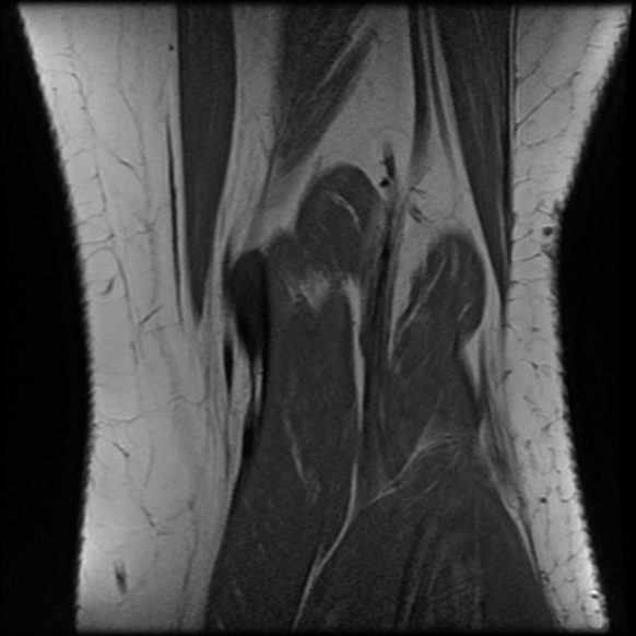File:Anterior cruciate ligament tear, Wrisberg rip and bucket-handle tear of medial meniscus (Radiopaedia 75872-87266 Coronal T1 24).jpg