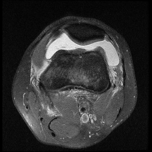 File:Anterior cruciate ligament tear (Radiopaedia 61500-69462 Axial PD fat sat 4).jpg
