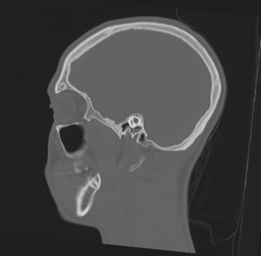 Anterior nasal spine fracture (Radiopaedia 46138-50494 Sagittal bone window 18).png