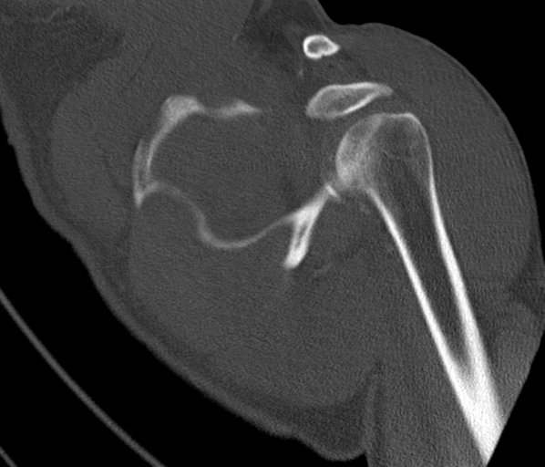 Anterior shoulder dislocation with Hill-Sachs and bony Bankart lesions (Radiopaedia 40424-42974 Coronal bone window 27).png