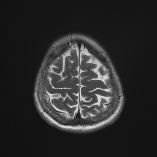 File:Anterior temporal encephalocele (Radiopaedia 82624-96808 Axial T2 34).jpg