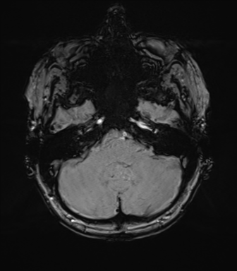 Anterior temporal lobe perivascular space (Radiopaedia 40946-43650 Axial SWI 18).png