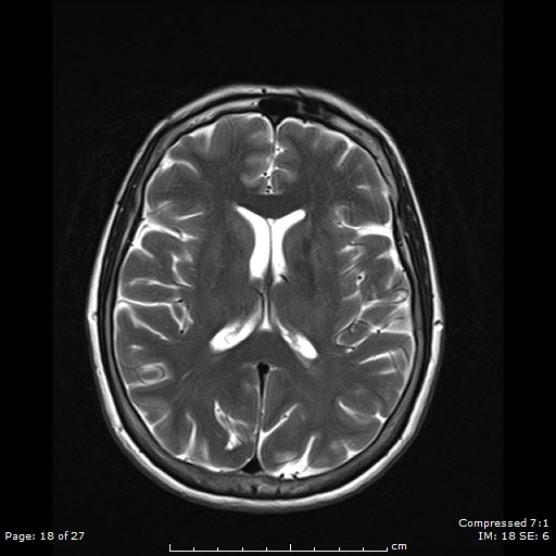 File:Anterior temporal lobe perivascular space (Radiopaedia 88283-104914 Axial T2 18).jpg