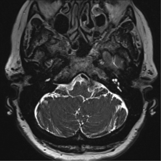 Anterior temporal pole cysts (Radiopaedia 46629-51102 Axial T2 22).png
