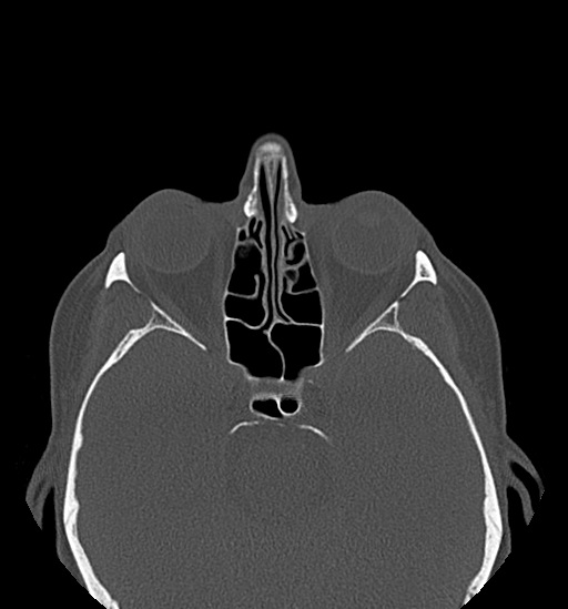 Anterior temporomandibular joint dislocation (Radiopaedia 59430-66784 Axial non-contrast 3).jpg