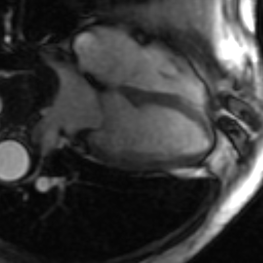 File:Anteroseptal hypokinesia after myocardial infarction (Radiopaedia 15978-15633 4 chamber view SSFE 1).jpg