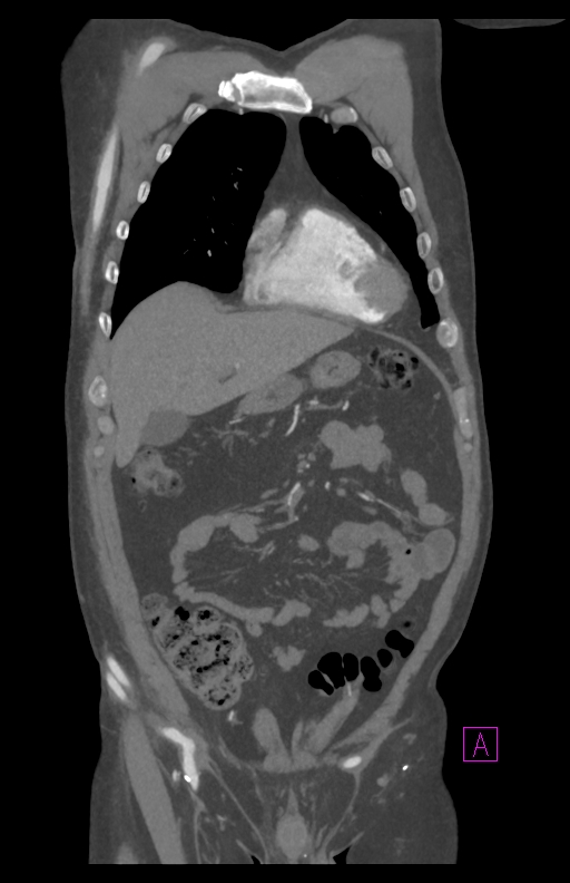 Aortectomy and axillary-bifemoral bypass (Radiopaedia 28303-28545 C 27).jpg