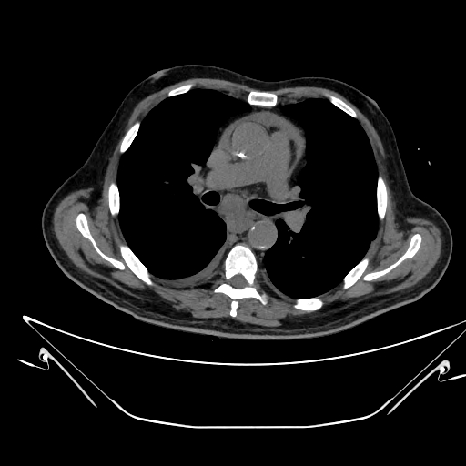 File:Aortic arch aneurysm (Radiopaedia 84109-99365 Axial non-contrast 128).jpg