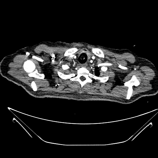 Aortic arch aneurysm (Radiopaedia 84109-99365 B 61).jpg