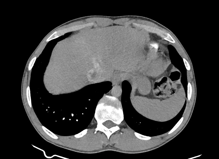 File:Aortic coarctation with aneurysm (Radiopaedia 74818-85828 A 50).jpg