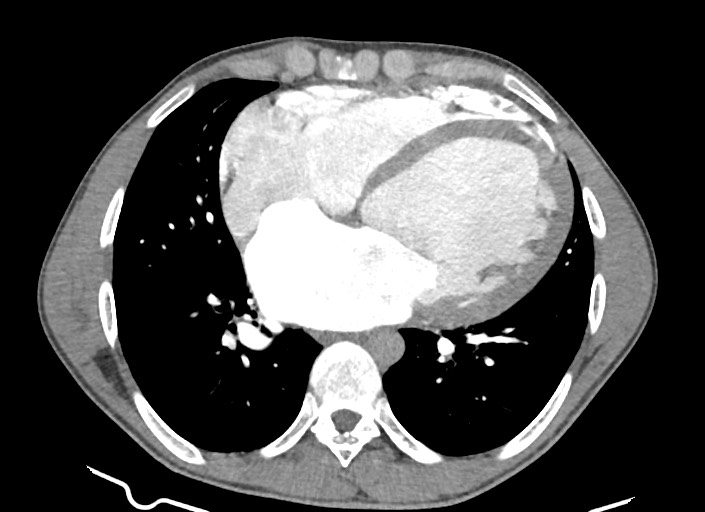 File:Aortic coarctation with aneurysm (Radiopaedia 74818-85828 A 89).jpg