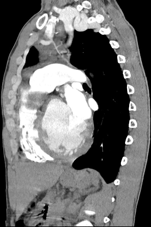 Aortic coarctation with aneurysm (Radiopaedia 74818-85828 B 99).jpg