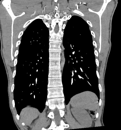 Aortic coarctation with aneurysm (Radiopaedia 74818-85828 C 88).jpg