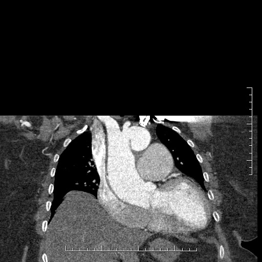 Aortic dissection- Stanford A (Radiopaedia 35729-37268 E 44).jpg