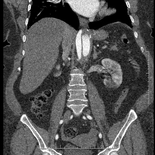 Aortic dissection- Stanford A (Radiopaedia 35729-37268 F 25).jpg