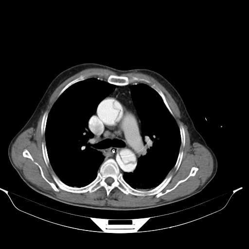 Aortic dissection- Stanford type A (Radiopaedia 22085-22085 A 19).jpg