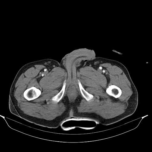 Aortic dissection- Stanford type A (Radiopaedia 22085-22085 A 86).jpg