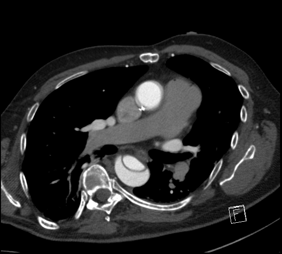 File:Aortic dissection (CTPA) (Radiopaedia 75506-86750 A 46).jpg
