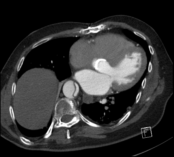 File:Aortic dissection (CTPA) (Radiopaedia 75506-86750 A 60).jpg