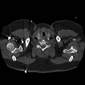 Aortic dissection (Radiopaedia 57969-64959 A 2).jpg
