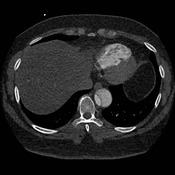 File:Aortic dissection (Radiopaedia 57969-64959 A 238).jpg