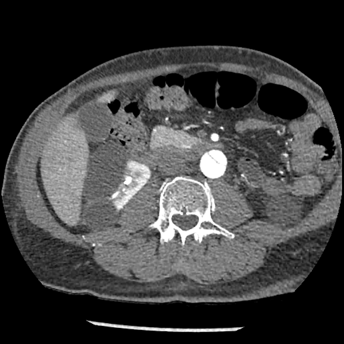 Aortic dissection - DeBakey Type I-Stanford A (Radiopaedia 79863-93115 A 54).jpg