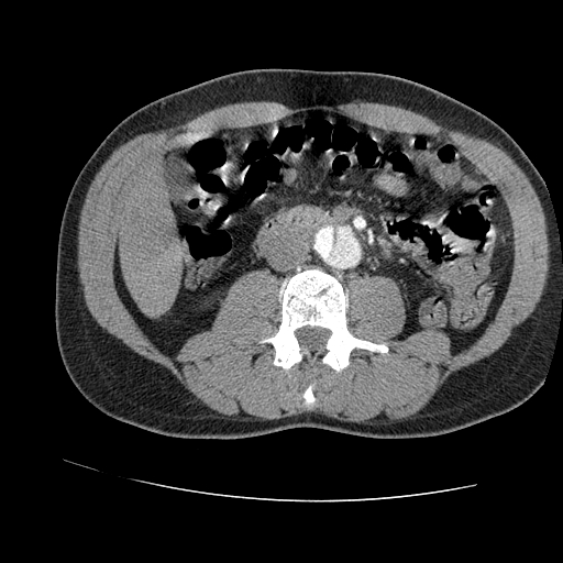 File:Aortic dissection - Stanford A -DeBakey I (Radiopaedia 28339-28587 B 144).jpg
