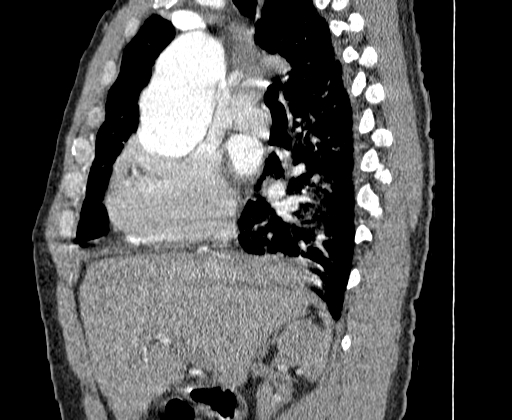 File:Aortic dissection - Stanford A -DeBakey I (Radiopaedia 28339-28587 C 3).jpg