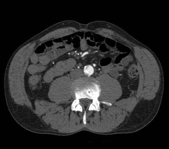 Aortic dissection - Stanford type B (Radiopaedia 73648-84437 A 182).jpg