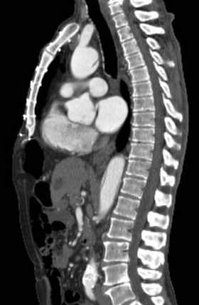 File:Aortic dissection - Stanford type B (Radiopaedia 73648-84437 C 77).jpg