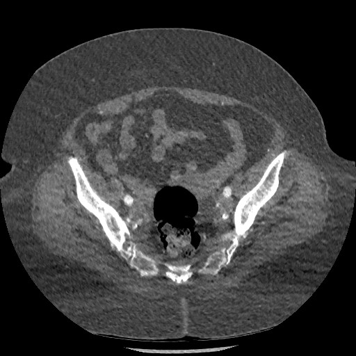 File:Aortic dissection - Stanford type B (Radiopaedia 88281-104910 A 147).jpg