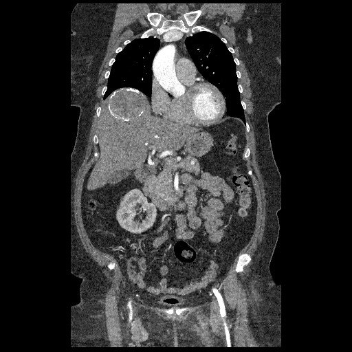 File:Aortic dissection - Stanford type B (Radiopaedia 88281-104910 B 18).jpg