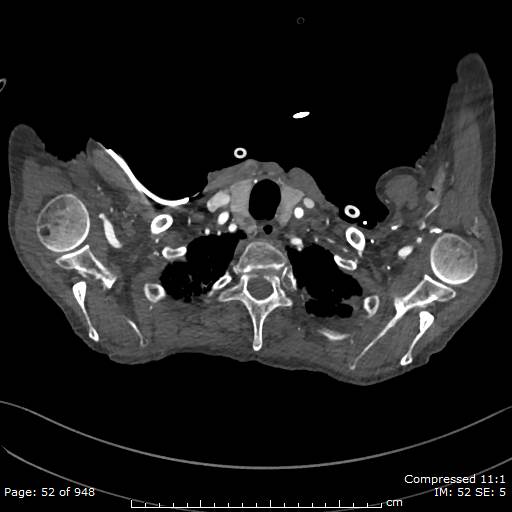 File:Aortic dissection with extension into aortic arch branches (Radiopaedia 64402-73204 B 52).jpg