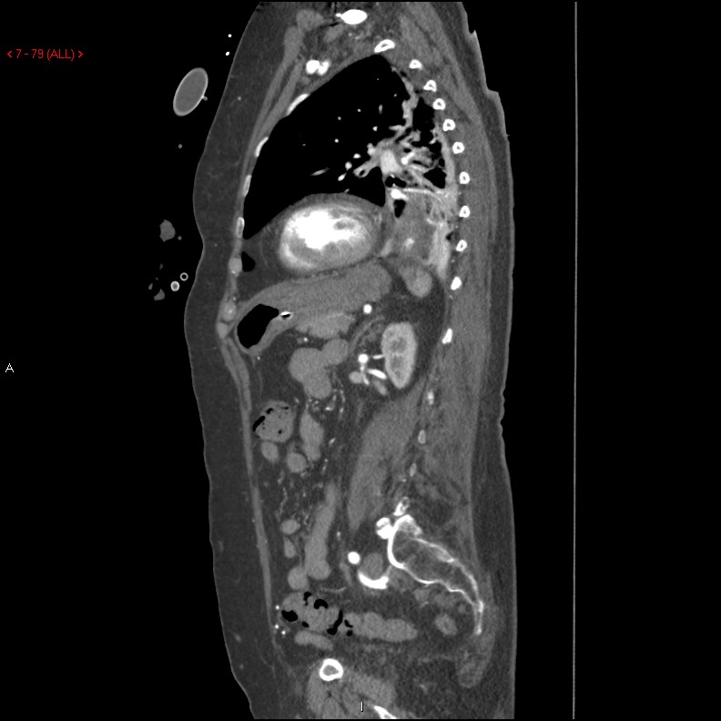 Aortic intramural hematoma (Radiopaedia 27746-28001 C 48).jpg